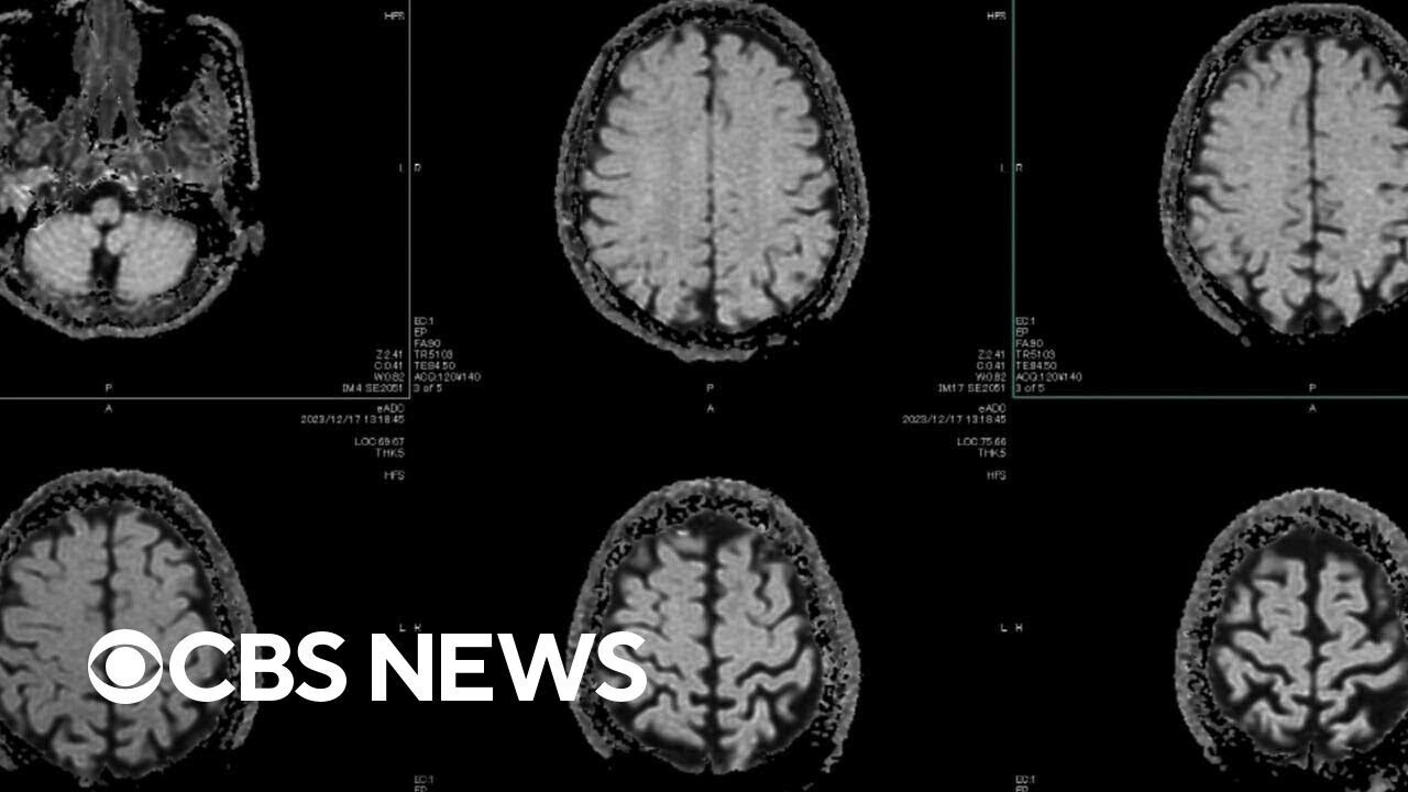 How CTE factors into the NYC mass shooting near the NFL headquarters